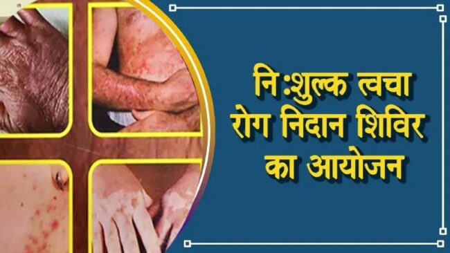 Betul Today News : विकृति बचाव एवं विशाल चर्म रोग निदान शिविर 30 जनवरी को