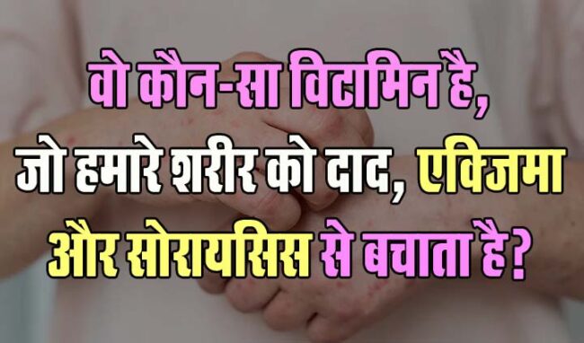 GK Questions : वो कौन-सा विटामिन है, जो हमारे शरीर को दाद, एक्जिमा और सोरायसिस से बचाता है?...